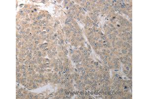 Immunohistochemistry of Human liver cancer using SLC1A4 Polyclonal Antibody at dilution of 1:70 (SLC1A4 抗体)