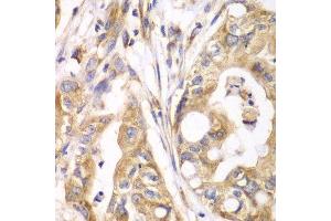 Immunohistochemistry of paraffin-embedded human liver cancer using TXNRD2 antibody. (TXNRD2 抗体  (AA 100-310))