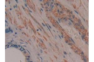 Detection of TTK in Human Prostate cancer Tissue using Polyclonal Antibody to TTK Protein Kinase (TTK)