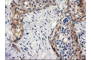 Immunohistochemical staining of paraffin-embedded Carcinoma of Human pancreas tissue using anti-BCAR1 mouse monoclonal antibody. (BCAR1 抗体)