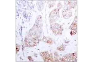 Immunohistochemistry analysis of paraffin-embedded human breast carcinoma tissue, using C-RAF (Ab-259) Antibody. (RAF1 抗体  (AA 225-274))
