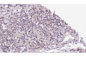 ABIN6273152 at 1/100 staining Human lymph cancer tissue by IHC-P. (PYGB 抗体  (C-Term))