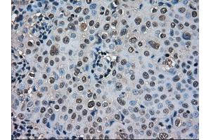 Immunohistochemical staining of paraffin-embedded Carcinoma of thyroid tissue using anti-SOD1mouse monoclonal antibody. (SOD1 抗体)