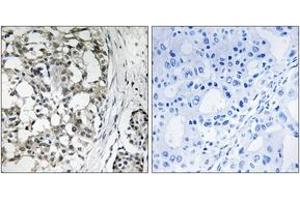 Immunohistochemistry analysis of paraffin-embedded human breast carcinoma tissue, using PEX14 Antibody. (PEX14 抗体  (AA 117-166))