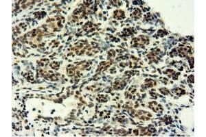 Immunohistochemical staining of paraffin-embedded Human breast tissue using anti-EPM2AIP1 mouse monoclonal antibody. (EPM2AIP1 抗体)