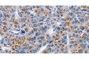 Immunohistochemistry of paraffin-embedded Human liver cancer tissue using CREB2 Polyclonal Antibody at dilution 1:40 (ATF4 抗体)