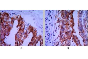 Immunohistochemical analysis of paraffin-embedded ovarian cancer (A), stomach cancer (B) using ALPP mouse mAb with DAB staining. (PLAP 抗体)