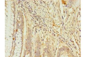 Immunohistochemistry of paraffin-embedded human colon cancer using ABIN7167621 at dilution of 1:100 (RGS7 抗体  (AA 1-487))