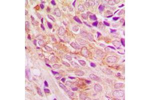 Immunohistochemical analysis of PI3K p110 alpha staining in human breast cancer formalin fixed paraffin embedded tissue section.