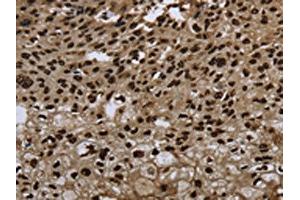 The image on the left is immunohistochemistry of paraffin-embedded Human esophagus cancer tissue using ABIN7189815(ANP32E Antibody) at dilution 1/20, on the right is treated with synthetic peptide. (ANP32E 抗体)