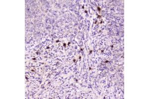 IHC testing of FFPE human sarcoma with Ribonuclease 3 antibody at 2ug/ml. (RNASE3 抗体  (AA 28-160))