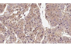 ABIN6269008 at 1/100 staining Human liver cancer tissue by IHC-P. (GLUT1 抗体  (C-Term))