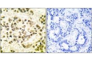 Immunohistochemistry analysis of paraffin-embedded human breast carcinoma, using STAT5B (Phospho-Ser731) Antibody. (STAT5B 抗体  (pSer731))