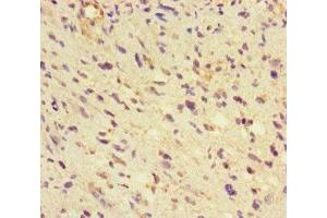 Immunohistochemistry of paraffin-embedded human glioma using ABIN7154022 at dilution of 1:100 (GLUL 抗体  (AA 86-373))