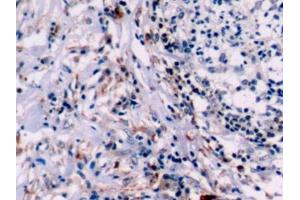 Detection of Bcl2 in Human Lymphoma Tissue using Polyclonal Antibody to B-Cell Leukemia/Lymphoma 2 (Bcl2)