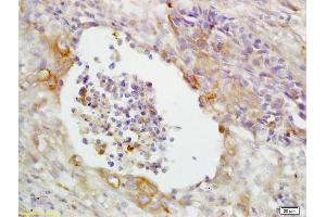 Formalin-fixed and paraffin embedded human lung carcinoma labeled with Anti-CD14 Polyclonal Antibody, Unconjugated (ABIN673164) at 1:200 followed by conjugation to the secondary antibody and DAB staining (CD14 抗体  (AA 201-300))