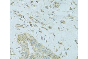 Immunohistochemistry of paraffin-embedded Human breast cancer using MTFP1 Polyclonal Antibody at dilution of 1:100 (40x lens). (Mtfp1 抗体)