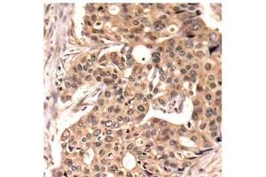 Immunohistochemistry of paraffin-embedded Human breast carcinoma tissue, using Phospho-PXN(Y118) Polyclonal Antibody (Paxillin 抗体  (pTyr118))