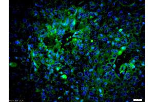 Formalin-fixed and paraffin embedded human laryngocarcinoma labeled with Anti-caspase-8 subunit p18 Polyclonal Antibody, Unconjugated (ABIN1386778) at 1:200 followed by conjugation to the secondary antibody Goat Anti-Rabbit IgG, AF488 conjugated used at 1:200 dilution for 40 minutes at 37°C and DAPI staining (Caspase 8 抗体  (AA 188-280))