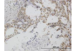 Immunoperoxidase of monoclonal antibody to POLR1C on formalin-fixed paraffin-embedded human pancreatic cancer.