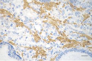 Immunohistochemistry was performed on paraffin-embedded human prostatic adenocarcinoma using desmin antibody (ABIN7798314), 1:200). (Recombinant Desmin 抗体)