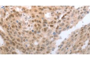 Immunohistochemistry of paraffin-embedded Human esophagus cancer tissue using SLC22A8 Polyclonal Antibody at dilution 1:70 (SLC22A8 抗体)