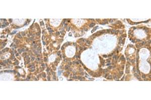 Immunohistochemistry of paraffin-embedded Human thyroid cancer tissue using KANSL1L Polyclonal Antibody at dilution of 1:80(x200) (KANSL1L 抗体)