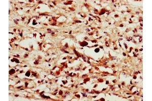 IHC image of ABIN7156872 diluted at 1:1400 and staining in paraffin-embedded human melanoma performed on a Leica BondTM system. (IL-24 抗体  (AA 52-207))
