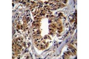 CAD antibody immunohistochemistry analysis in formalin fixed and paraffin embedded human breast carcinoma. (CAD 抗体  (AA 780-809))