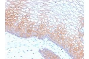 Immunohistochemistry (Formalin-fixed Paraffin-embedded Sections) (IHC (fp)) image for anti-Cadherin 1, Type 1, E-Cadherin (Epithelial) (CDH1) antibody (ABIN5707887)