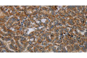 Immunohistochemistry of paraffin-embedded Human thyroid cancer tissue using HSD17B14 Polyclonal Antibody at dilution 1:40 (HSD17B14 抗体)