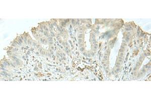 Immunohistochemistry of paraffin-embedded Human thyroid cancer tissue using C8orf4 Polyclonal Antibody at dilution of 1:55(x200) (C8orf4 抗体)