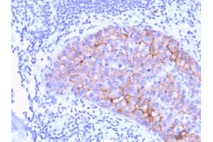 Formalin-fixed, paraffin-embedded human Breast Carcinoma stained with HER-2 Mouse Monoclonal Antibody (ERBB2/3078). (ErbB2/Her2 抗体  (AA 311-462))