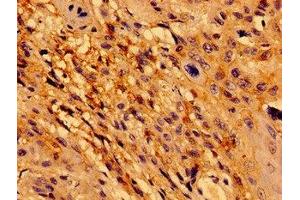 Immunohistochemistry of paraffin-embedded human cervical cancer using ABIN7172450 at dilution of 1:100 (TCF15 抗体  (AA 24-199))