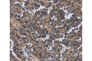 Immunohistochemistry of Human ovarian cancer using ITGAE Polyclonal Antibody at dilution of 1:50 (CD103 抗体)