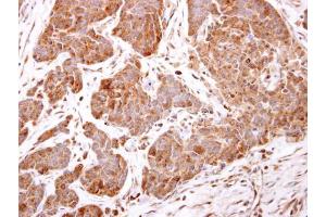 IHC-P Image ARF5 antibody detects ARF5 protein at cytosol on human breast carcinoma by immunohistochemical analysis. (ARF5 抗体)