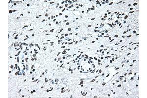 Immunohistochemical staining of paraffin-embedded Adenocarcinoma of breast tissue using anti-IRF3 mouse monoclonal antibody. (IRF3 抗体)