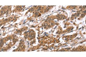 Immunohistochemistry of paraffin-embedded Human gastric cancer tissue using BNIP2 Polyclonal Antibody at dilution 1:50