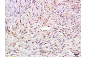 Formalin-fixed and paraffin embedded human cervical carcinoma labeled with Anti ATAD2 Polyclonal Antibody, Unconjugated (ABIN1386935) at 1:200 followed by conjugation to the secondary antibody and DAB staining (ATAD2 抗体  (AA 1025-1063))