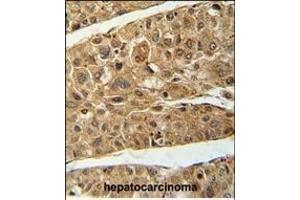 RT4I1 Antibody (C-term) (ABIN654729 and ABIN2844417) immunohistochemistry analysis in formalin fixed and paraffin embedded human hepatocarcinoma followed by peroxidase conjugation of the secondary antibody and DAB staining. (RTN4IP1 抗体  (C-Term))