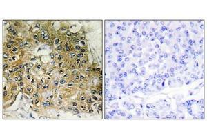 Immunohistochemical analysis of paraffin-embedded human breast carcinoma tissue using Integrin β1 (Phospho-Thr789) antibody (left)or the same antibody preincubated with blocking peptide (right). (ITGB1 抗体  (pThr789))