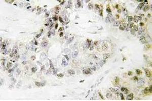Immunohistochemistry (IHC) analyzes of Pitx1 antibody in paraffin-embedded human lung carcinoma tissue. (PITX1 抗体)