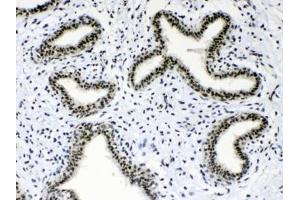 IHC testing of FFPE human breast cancer tissue with Musashi antibody at 1ug/ml. (MSI1 抗体  (AA 21-54))