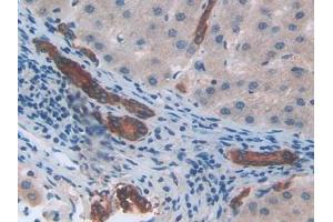IHC-P analysis of Human Liver cancer Tissue, with DAB staining. (CXCL2 抗体  (AA 34-107))
