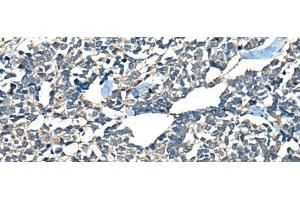 Immunohistochemistry of paraffin-embedded Human lung cancer tissue using CDADC1 Polyclonal Antibody at dilution of 1:60(x200) (CDADC1 抗体)