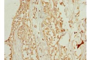 Immunohistochemistry of paraffin-embedded human breast cancer using ABIN7175750 at dilution of 1:100 (WDR38 抗体  (AA 1-314))
