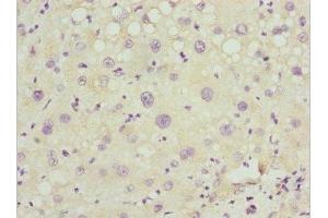 Immunohistochemistry of paraffin-embedded human liver cancer using ABIN7162977 at dilution of 1:100 (PEX14 抗体  (AA 118-377))