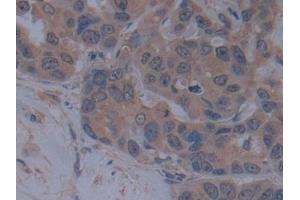Detection of TICAM1 in Human Breast cancer Tissue using Polyclonal Antibody to Toll Like Receptor Adaptor Molecule 1 (TICAM1) (TICAM1 抗体  (AA 443-685))