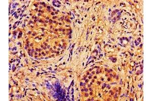 Immunohistochemistry of paraffin-embedded human pancreatic cancer using ABIN7144893 at dilution of 1:100 (ABCB7 抗体  (AA 23-140))