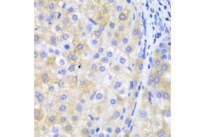 Immunohistochemistry of paraffin-embedded human liver cancer using FTH1 antibody at dilution of 1:100 (400x lens). (FTH1 抗体)
